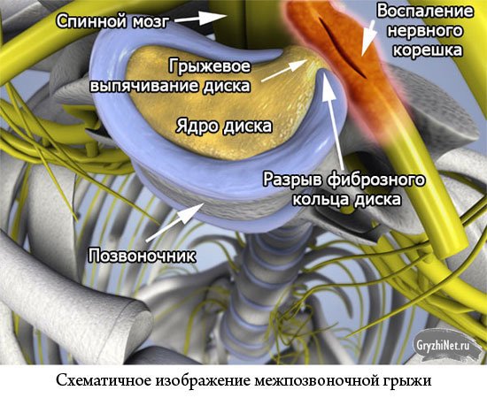 схематичное изображение грыжи диска